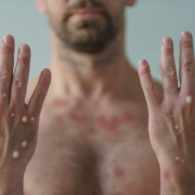 Monkeypox